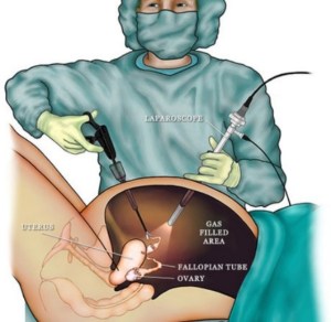 A brief look at how they do the surgery - simplified! For mine they will navigate all the way up to the liver then back down.